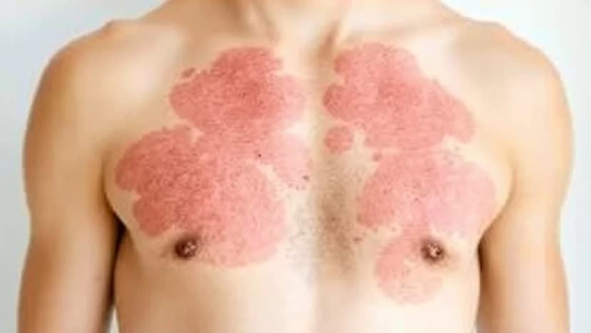 Röda utslag på bröstet som inte kliar